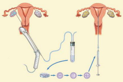 体外受精（IVF）