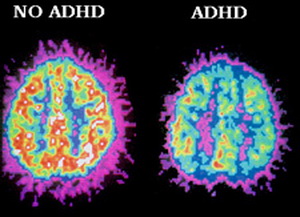 ADHD大脑