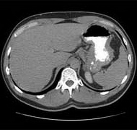 肝脏CT扫描