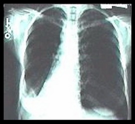 肺减容术