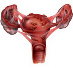 子宫内膜组织异位