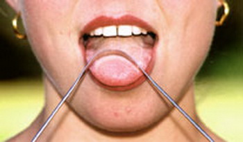 舌头白膜