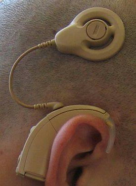 人工耳蜗