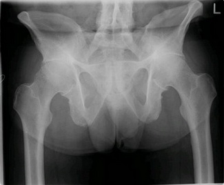 强直性脊柱炎诊断 (X线检查)