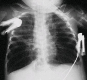 胸部X线