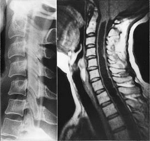 CT脊髓造影术