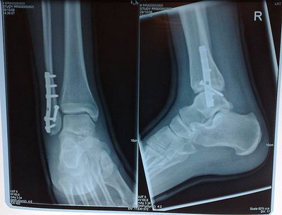踝部骨折手术治疗(或足部骨折手术治疗)