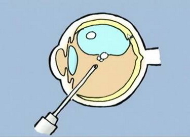 充气性视网膜固定术