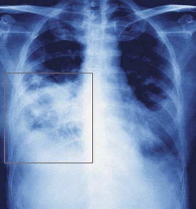 重症肺炎胸片图片