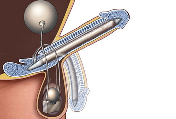 人工阴茎植入