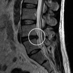 椎间盘突出诊断