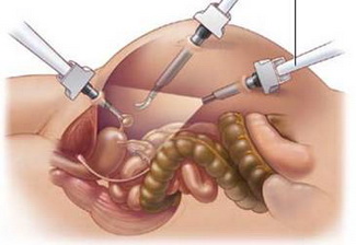 预防性卵巢切除术