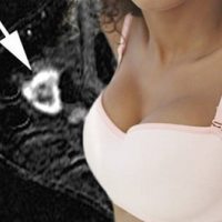 年轻乳腺癌患者治疗后更容易出现复发
