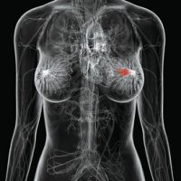 他汀类药物可能对治疗乳腺癌有效