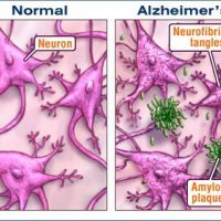 研究发现一种可迅速改善老年痴呆症的药物